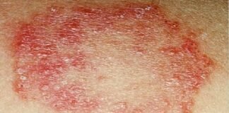 बारिश की नमी बनी त्वचा रोगों का सबब, फंगल इंफेक्शन और खुजली के मामले बढ़े।